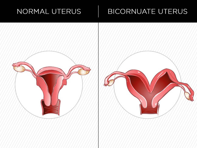 Bicornuate Uterus: What Does It Look Like?