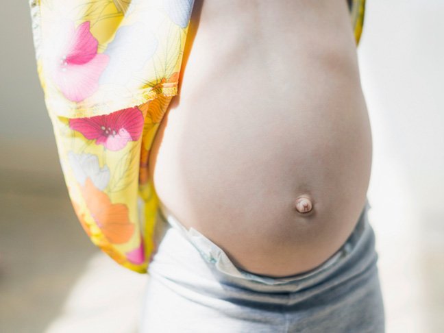 what-causes-an-outie-belly-button